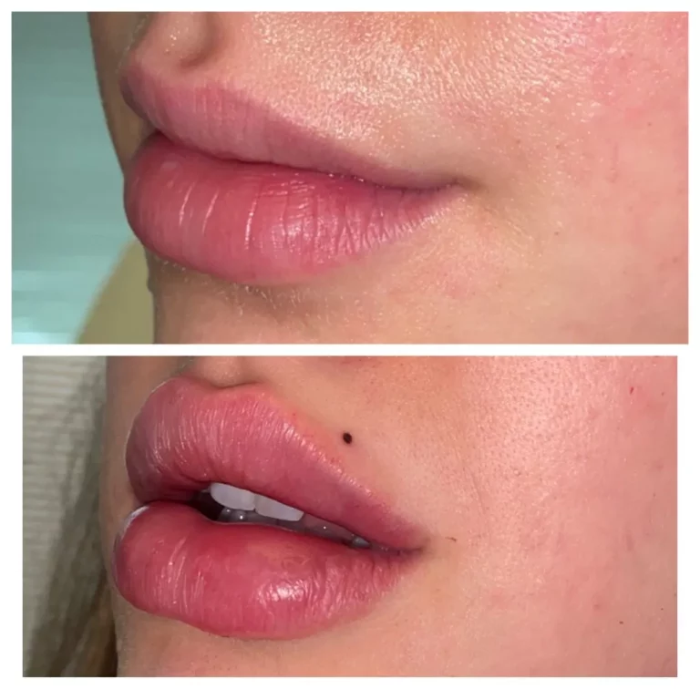best lip fillers in Gilbert