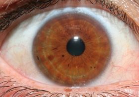 Stress Rings Eyes: Causes, Symptoms, and Solutions