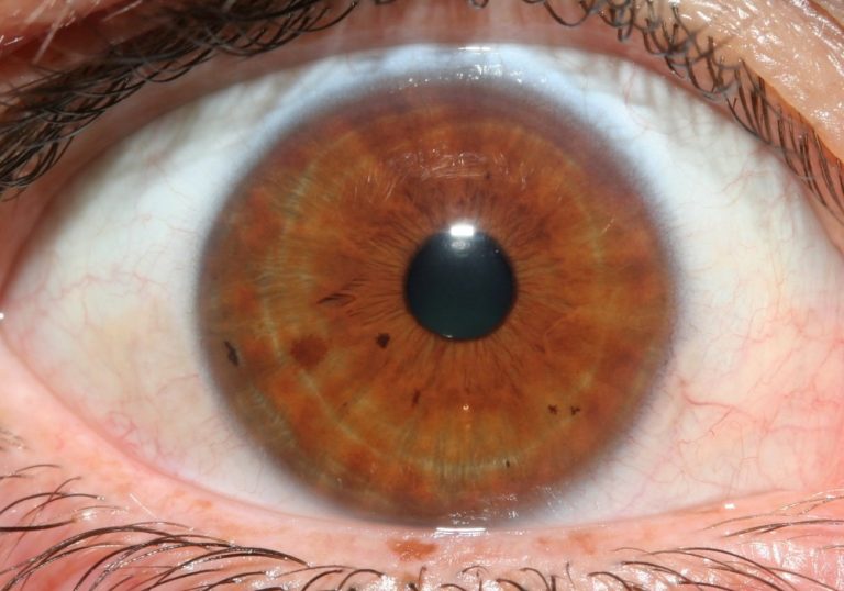 stress rings eyes